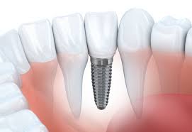 Scopri di più sull'articolo Impianti dentali a Bologna con le moderne tecnologie mediche